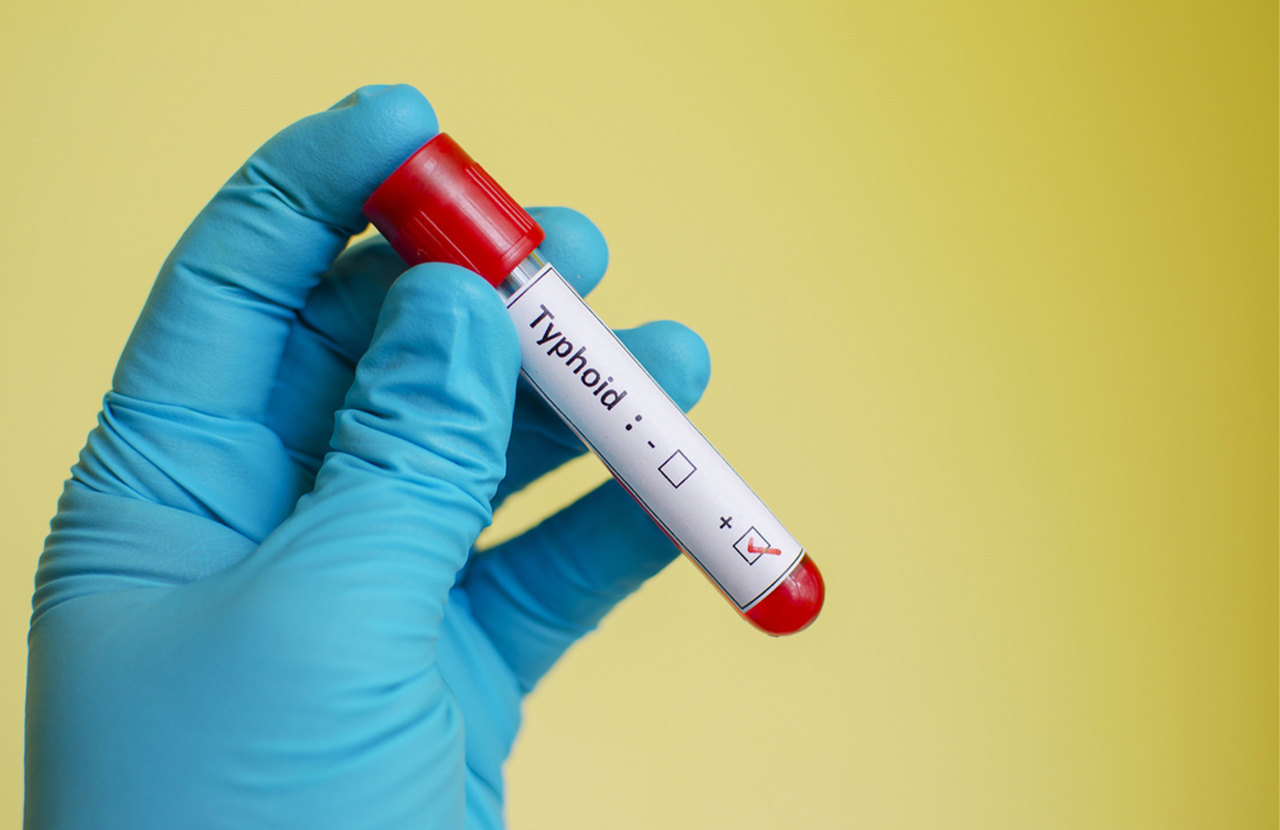 Pemeriksaan Tubex TF untuk Pemeriksaan Demam Tifoid